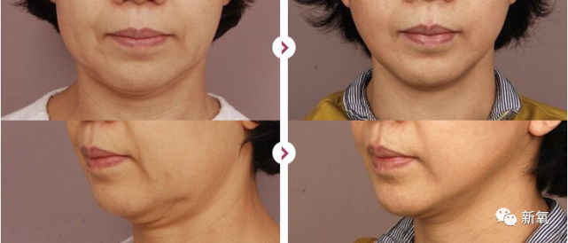 如果是皮肤松弛下垂导致的就有用,胖出来的打一万次都作用不大.