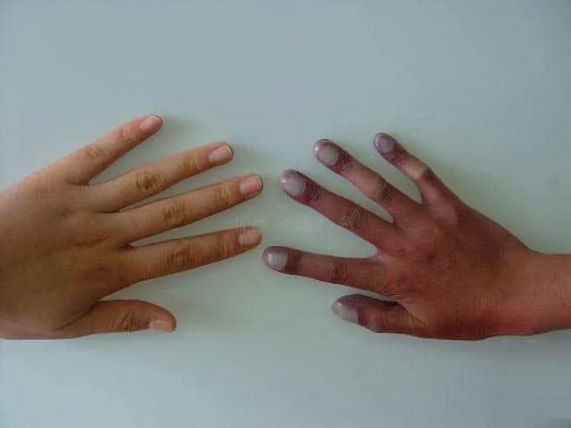 手足发绀?千别疏忽!