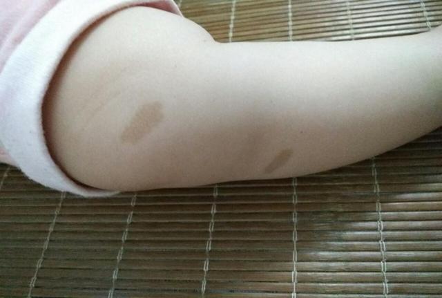 胎记"与生俱来",管不住嘴又迈不开腿,宝妈难辞其咎