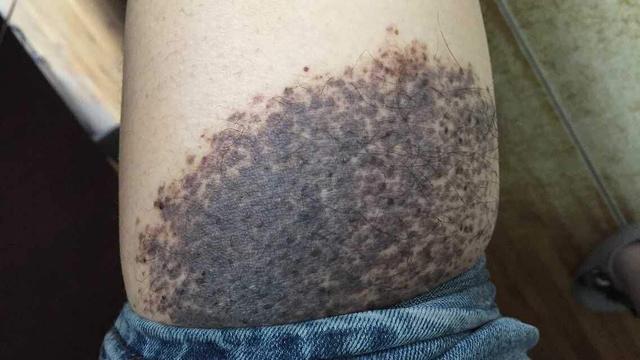 胎记与生俱来管不住嘴又迈不开腿宝妈难辞其咎