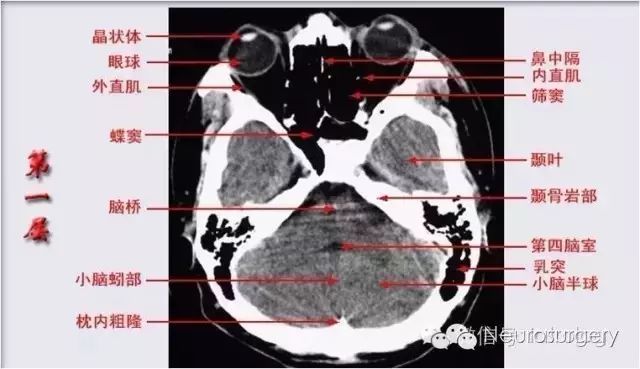 分層軸位解剖四竇:額,篩,蝶竇乳突,上頜竇三室:三,四,側腦室9.