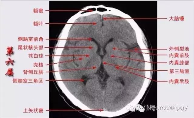 已收藏!颅脑ct解剖口诀 彩色解剖图