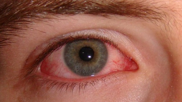 新冠肺炎眼睛红图片
