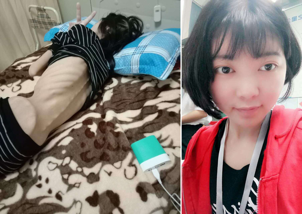 24岁美女因重度营养不良进icu如今瘦到只有50斤