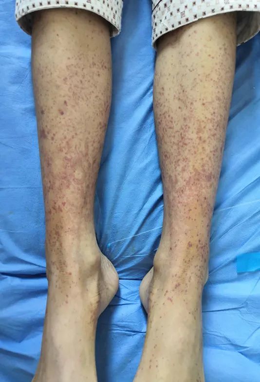 孩子得了过敏性紫癜怎么办