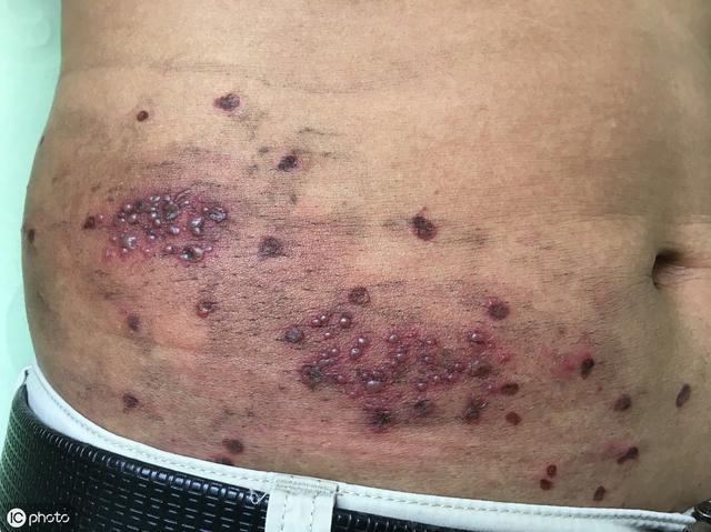 有人说腰缠蛇绕一圈就治不了咱没见过就治龇治