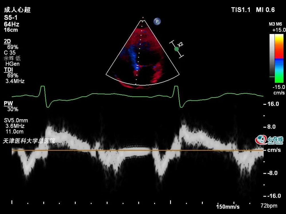 心动在线丨从一则非典型病例看超声心动图在冠心病诊疗中的价值