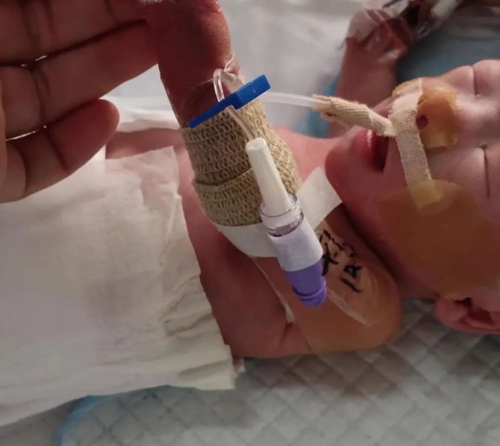 拯救袖珍宝宝——区人民医院首例早产儿picc置管成功