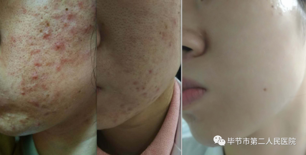 no.7 光动力治疗"青春痘"的过程如何?