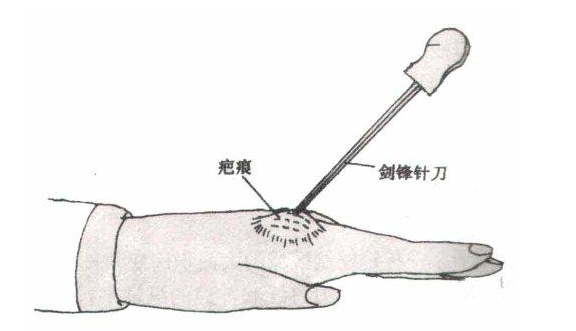 (二)针刀松解:1.体位 同前.2.穿刺点定位 同前.3.