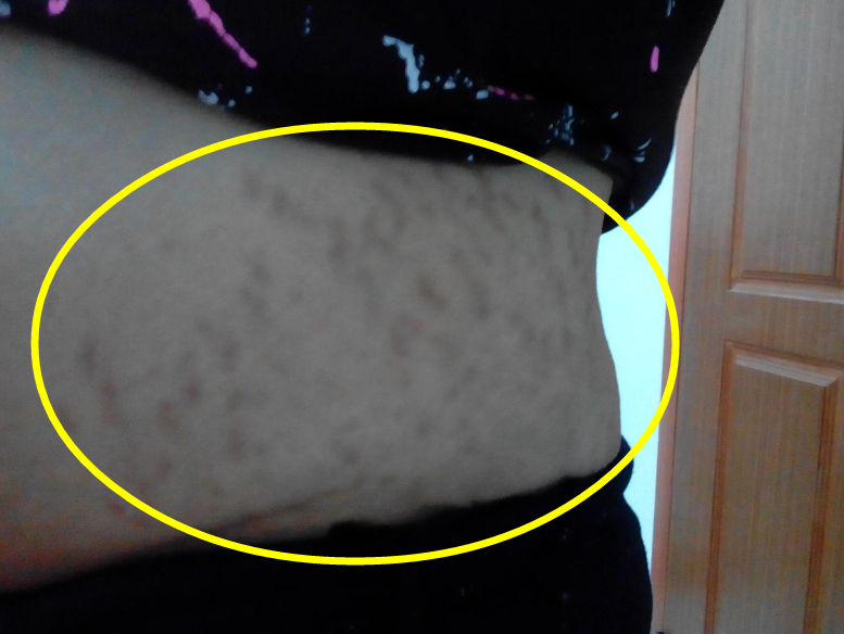 为啥怀孕没有妊娠纹,孩子出生却有了?过来人讲讲自己的经验