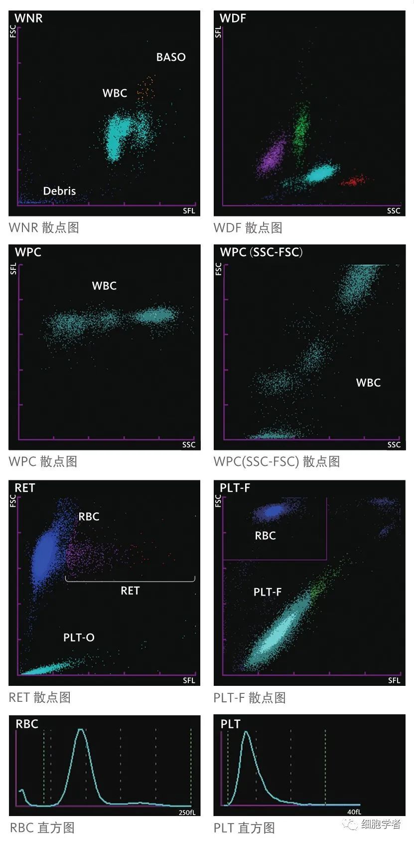 72 急性髓細胞白血病部分分化型aml-m2病例wbc flagswbc abn