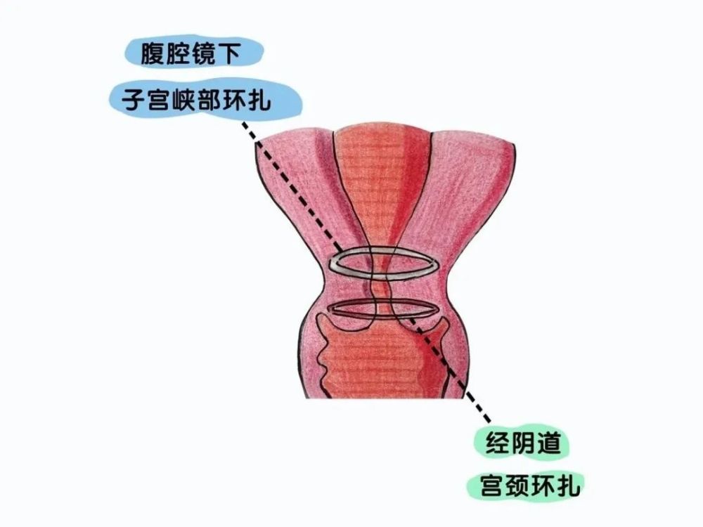 宮頸機能不全——孕期流產的罪魁禍首之一_騰訊新聞