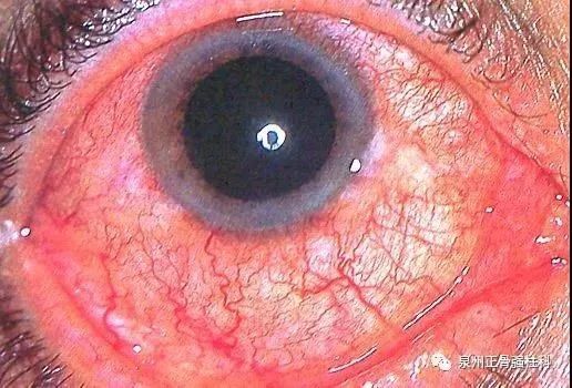 眼红,眼痛,畏光,流泪……当强直性脊柱炎"遇上"葡萄膜炎