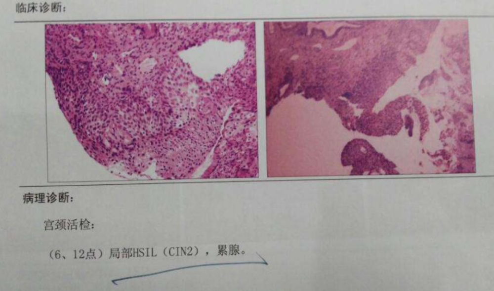 hpv66,cinii病变,手术后还是阳性!如今终于转阴绝不是因为幸运