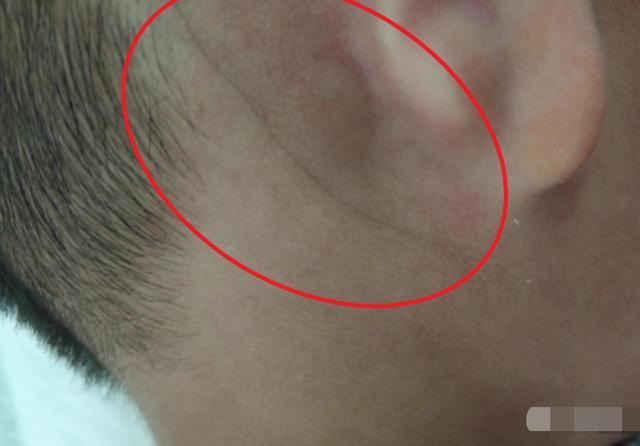 4岁男童耳朵长"黑线"还会动,妈妈带去检查后,医生:太少见