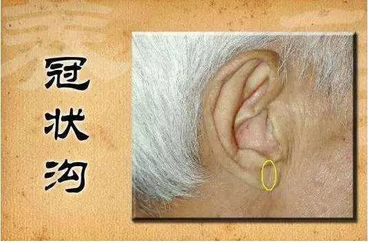 耳垂冠心病沟