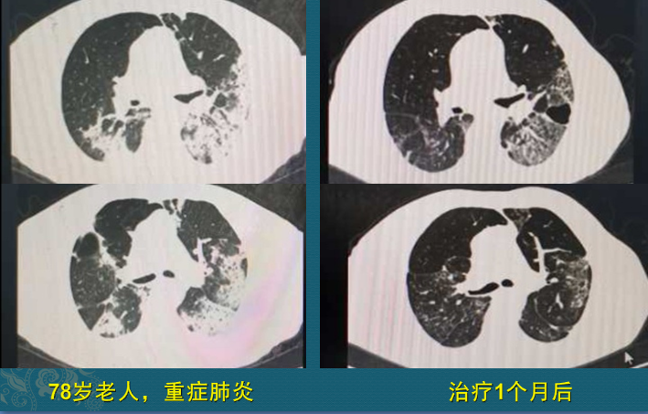 新冠肺炎康复后会不会遗留肺纤维化占多少比例