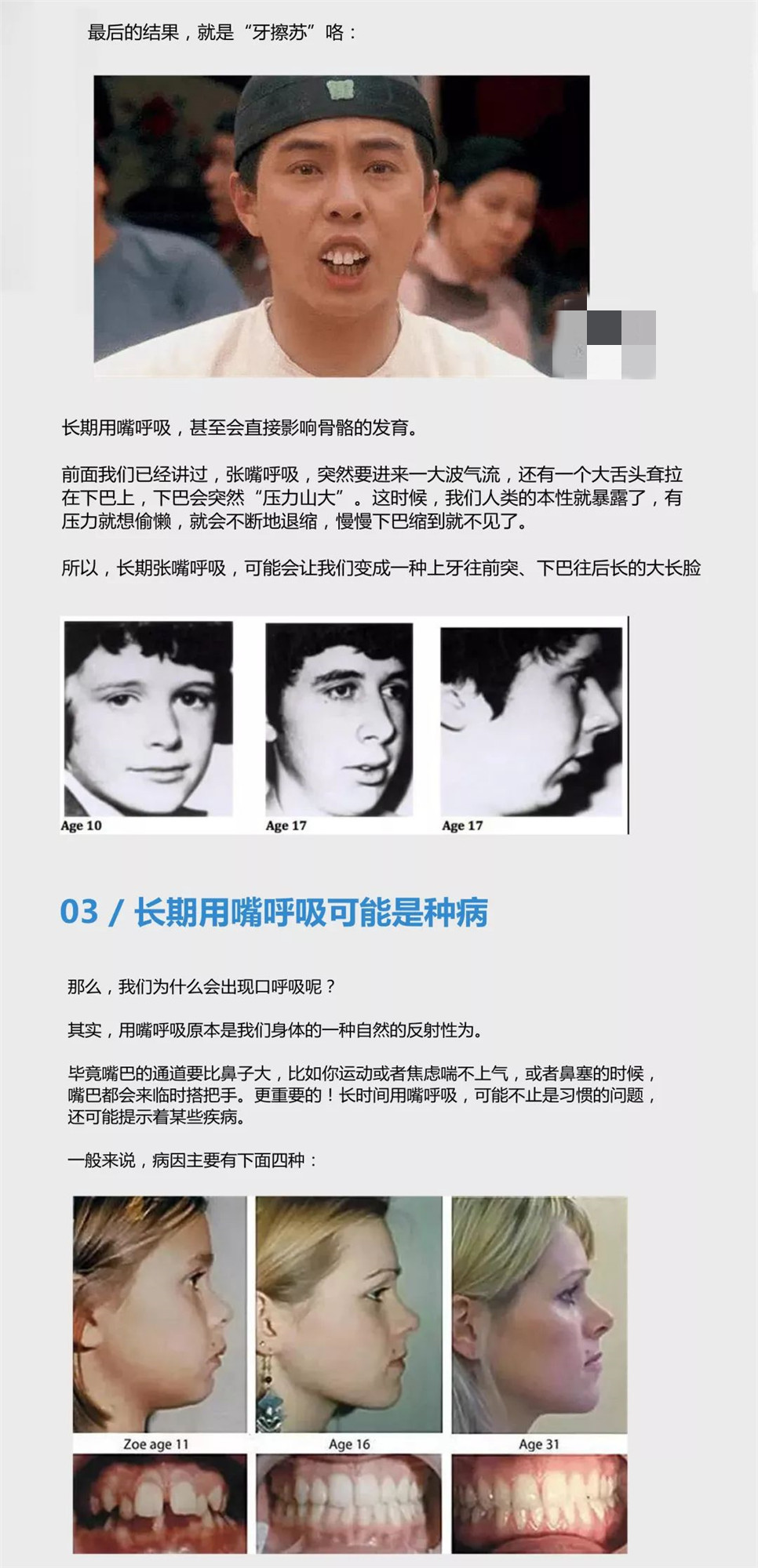 习惯用嘴呼吸真的会改变人的脸型吗?答案是