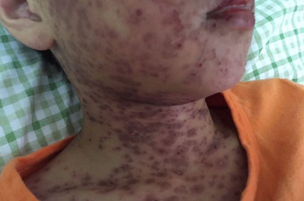 小男孩眼结膜充血发热3天全身红色斑丘疱疹密密麻麻
