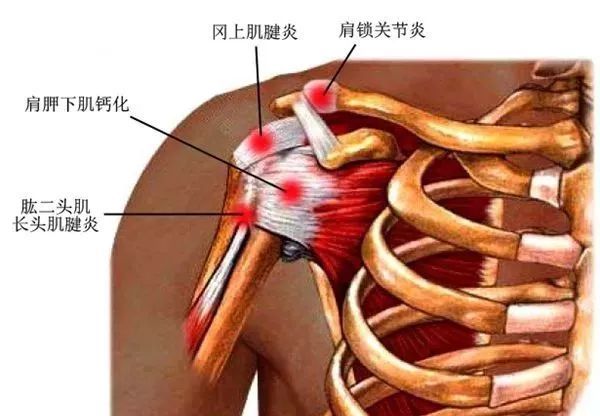 鈣化約80%會發生在岡上肌腱,也可累及肩袖的其它肌肉,一般表現為患肢