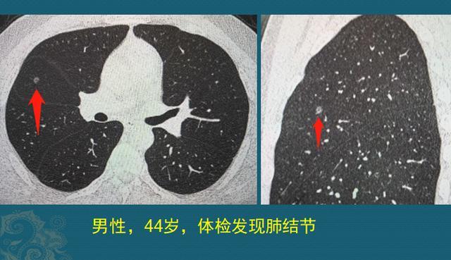从1个癌细胞 长成3cm肺癌肿块大概要几年 腾讯新闻