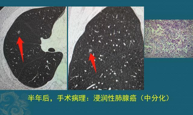 从1个癌细胞 长成3cm肺癌肿块大概要几年 腾讯新闻