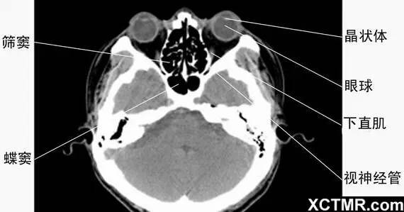 全面總結|頭頸五官ct解剖圖