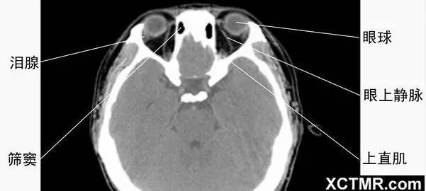 全面總結|頭頸五官ct解剖圖