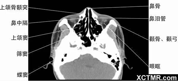 全面總結|頭頸五官ct解剖圖