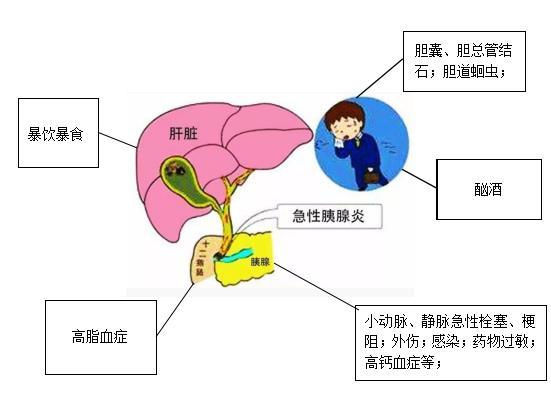 一顿饭要了一条人命这事真的有急性胰腺炎你需要了解一下