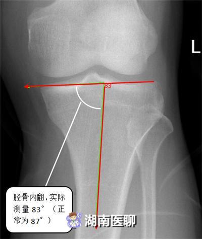 男子一运动膝盖就痛 检查显示骨挫伤 惹祸 的竟是o型腿 膝关节 O型腿 湖南省第二人民医院 膝盖 骨挫伤 膝关节疼痛