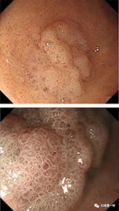 盘点幽门螺杆菌阴性早期胃癌的6种类型