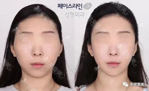 颧骨内推不用钛钉固定危险系数评估 并非人人适合不固定方式 腾讯新闻