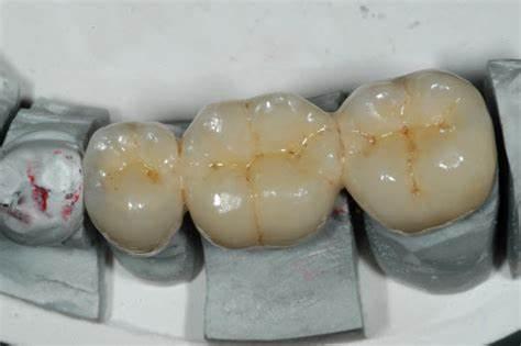 吃货的悲哀:一不小心缺掉第一颗大牙,怎么办?口腔医生为你说说