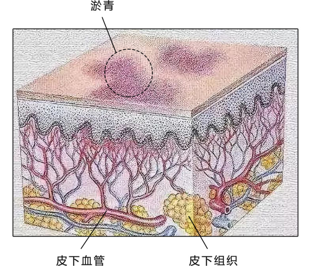 女生身上有淤青,是怎么回事?