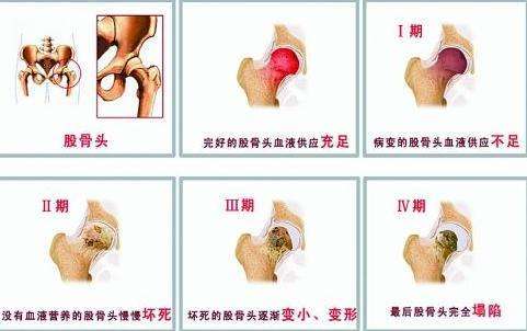 一张图片告诉你股骨头坏死治疗为什么要恢复血运