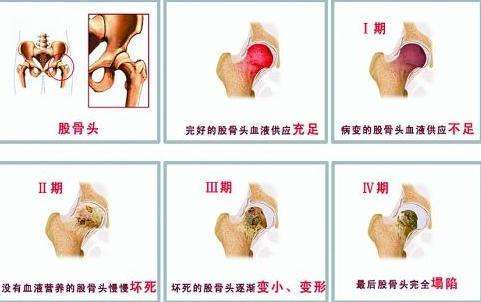 股骨头本身血液循环系统较弱,受到上述原因的影响,股骨头得不到血液