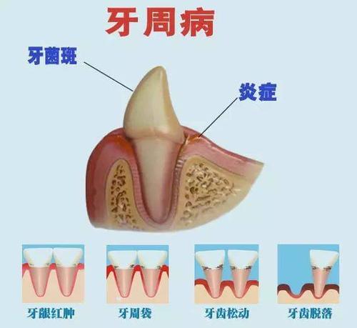 增加蛀牙的概率,临床上,牙齿不齐的患者患龋的概率要比整齐的高很多