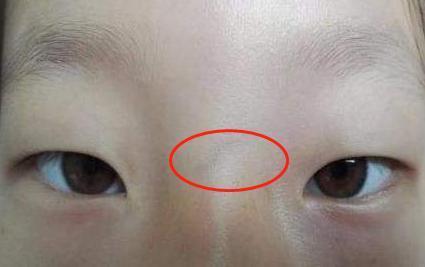 如果家长发现孩子鼻梁处有明显的青筋,也要帮孩子查一下是不是积食了