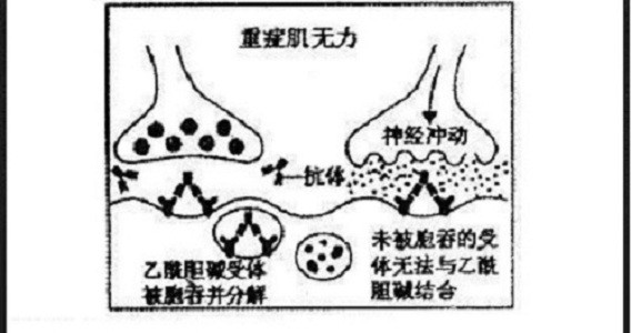 固元提肌湯帶你瞭解重症肌無力及治療方法