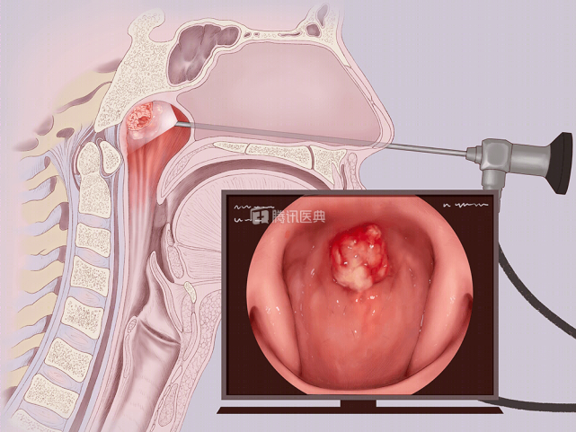 鼻咽癌治疗起效后想要维持疗效一定要牢记这3点很重要以防复发