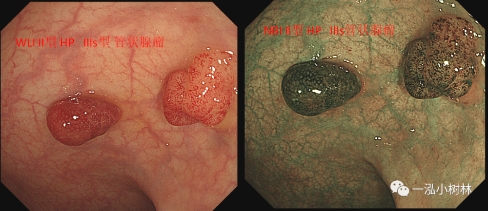 绒毛管状腺瘤或者tsa?