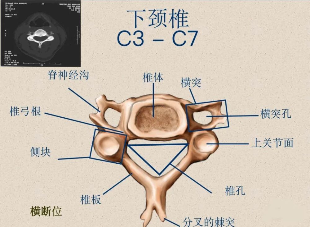 較大橫突——橫突孔,椎動脈,神經根溝齒狀突——寰椎的旋轉中心樞椎