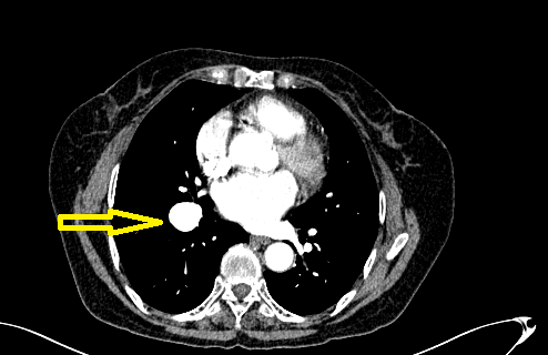 图7 图9 案例6 有些血管畸形,隐藏在肺部感染的病灶中,ct平扫是没有