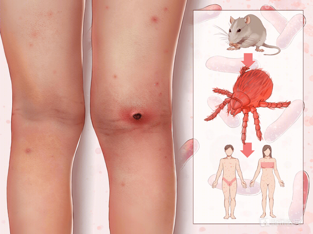 蜱虫蜱虫在夏季活动频繁,通常出没在草