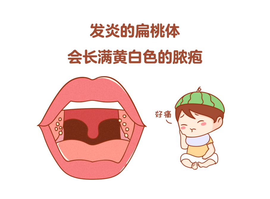 扁桃体结石的症状与扁桃发体炎类似,都是喉咙有异物感,吞咽困难疼痛