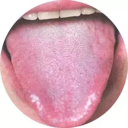 中医教你如何从舌头看胃部是否健康?
