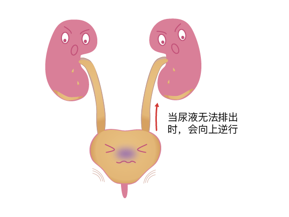 甚至能完全封闭尿道,那时患者就想尿也尿不出来,发生严重的『尿潴留』