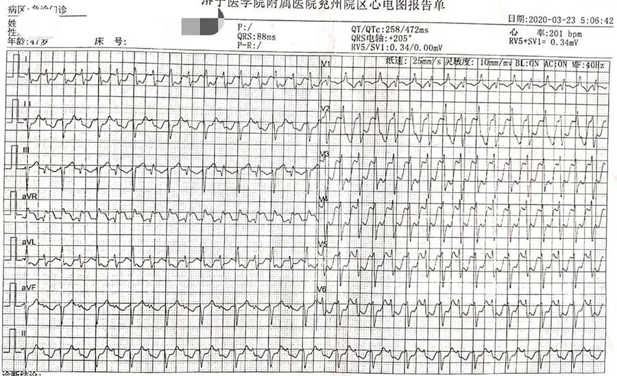 乌头碱中毒致电风暴,8 张图带你来了解